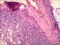 肾血管平滑肌脂肪瘤图16