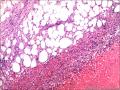 肾血管平滑肌脂肪瘤图22