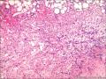 肾血管平滑肌脂肪瘤图7