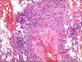 肾血管平滑肌脂肪瘤图9