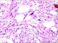 肾血管平滑肌脂肪瘤图15