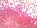 肾血管平滑肌脂肪瘤图5