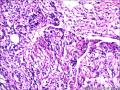 肾血管平滑肌脂肪瘤图12