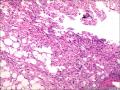 肾血管平滑肌脂肪瘤图10