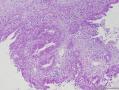 右侧卵巢与子宫双部位肿瘤图17