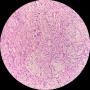 卵巢Brenner瘤图3