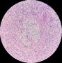 卵巢Brenner瘤图5