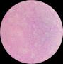 卵巢Brenner瘤图1
