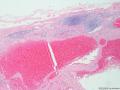 海绵状血管瘤会在淋巴结内出现吗?图2
