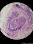 双侧乳腺肿物（冰冻切片，石蜡切片明确浸润性导管癌）图19