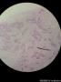 双侧乳腺肿物（冰冻切片，石蜡切片明确浸润性导管癌）图7