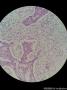 双侧乳腺肿物（冰冻切片，石蜡切片明确浸润性导管癌）图12