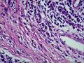 皮下结节（是否梭形细胞血管内皮瘤？）图40