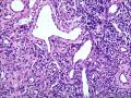 皮下结节（是否梭形细胞血管内皮瘤？）图55