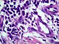 皮下结节（是否梭形细胞血管内皮瘤？）图42