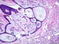 皮下结节（是否梭形细胞血管内皮瘤？）图34