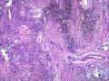 皮下结节（是否梭形细胞血管内皮瘤？）图37