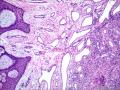 皮下结节（是否梭形细胞血管内皮瘤？）图35