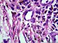 皮下结节（是否梭形细胞血管内皮瘤？）图46