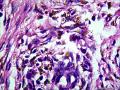 皮下结节（是否梭形细胞血管内皮瘤？）图47