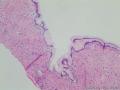 卵巢囊性肿瘤图1