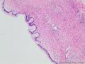卵巢囊性肿瘤图3