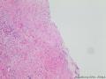 卵巢囊性肿瘤图7