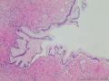 卵巢囊性肿瘤图8