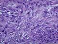 肌纤维母细胞肿瘤？图4