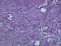 肌纤维母细胞肿瘤？图1