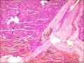 骶椎管肿物图5