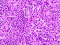 腹腔肿物：淀粉样变和浆细胞比较突出？图23