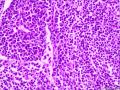腹腔肿物：淀粉样变和浆细胞比较突出？图24