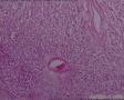 隐睾：精原细胞瘤？图3