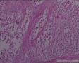 隐睾：精原细胞瘤？图1