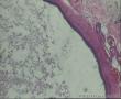隐睾手术发现睾丸鞘膜灰白色米粒大小囊肿图4