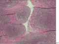 扁桃体淋巴滤泡生发中心外较多核分裂像，有问题没？图1
