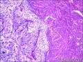 腺肌瘤伴子宫内膜间质粘液变？图2