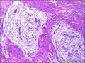 腺肌瘤伴子宫内膜间质粘液变？图3