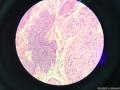 可见两种形态肿瘤细胞，是否为皮脂腺癌？图8