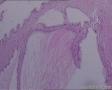 子宫粘膜下肿物：颈管息肉？图2