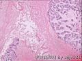 卵巢囊性肿物图4