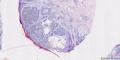 鼻根部色素性基底细胞癌图3