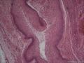 宫颈赘生物图8