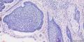 鼻根部色素性基底细胞癌图7