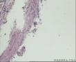 请老师看看卵巢黄体囊肿，囊壁内衬的黄体细胞异型性这麽大？图8