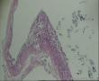 请老师看看卵巢黄体囊肿，囊壁内衬的黄体细胞异型性这麽大？图10