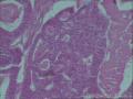左侧卵巢，子宫内膜癌转移，图1-6子宫内膜。7-23卵巢图19