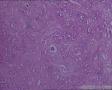 左大腿肿物：非典型性纤维组织细胞瘤？恶纤组？图9