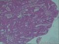 左侧卵巢，子宫内膜癌转移，图1-6子宫内膜。7-23卵巢图12